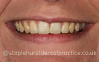 After - Staplehurstdentalpractice