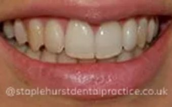 After - Staplehurstdentalpractice