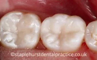 After - Staplehurstdentalpractice