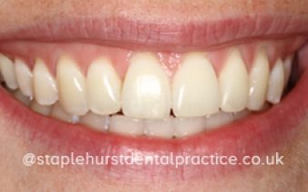 After - Staplehurstdentalpractice
