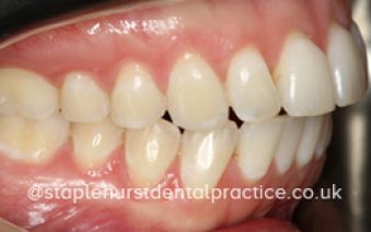 After - Staplehurstdentalpractice