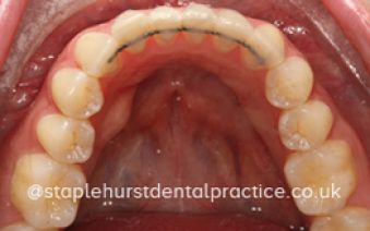 After - Staplehurstdentalpractice