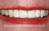 After - Staplehurstdentalpractice