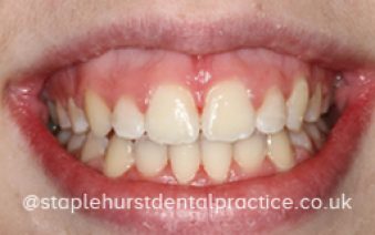 After - Staplehurstdentalpractice