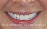 After - Staplehurstdentalpractice