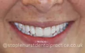After - Staplehurstdentalpractice