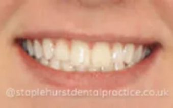 After - Staplehurstdentalpractice