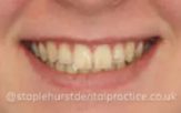Before - Staplehurstdentalpractice