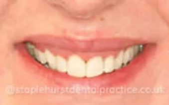 After - Staplehurstdentalpractice