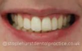 After - Staplehurstdentalpractice