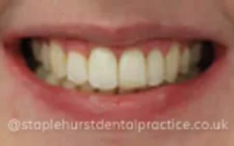 After - Staplehurstdentalpractice