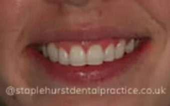 After - Staplehurstdentalpractice