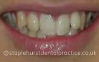 Before - Staplehurstdentalpractice