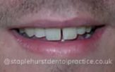 Before - Staplehurstdentalpractice