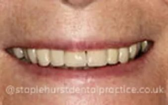 After - Staplehurstdentalpractice