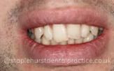 Before - Staplehurstdentalpractice